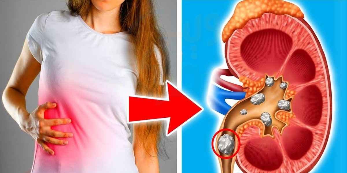 Gurde Ki Pathri Khatam Karne Ka Tarika In Urdu Women Health And Fitness